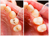 Composite-Filling